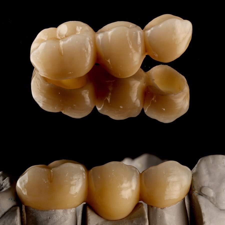 All ceramic crowns @ Crilly Dental
