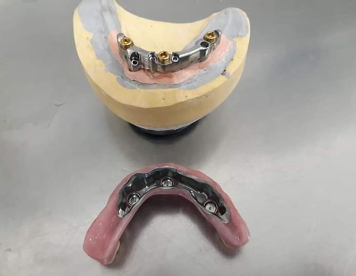 implant denture @ dundee dental lab